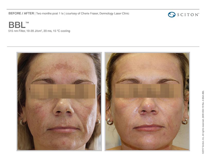 BBL BroadBand Light Photofacial in Los Angeles Skin Rejuvenation