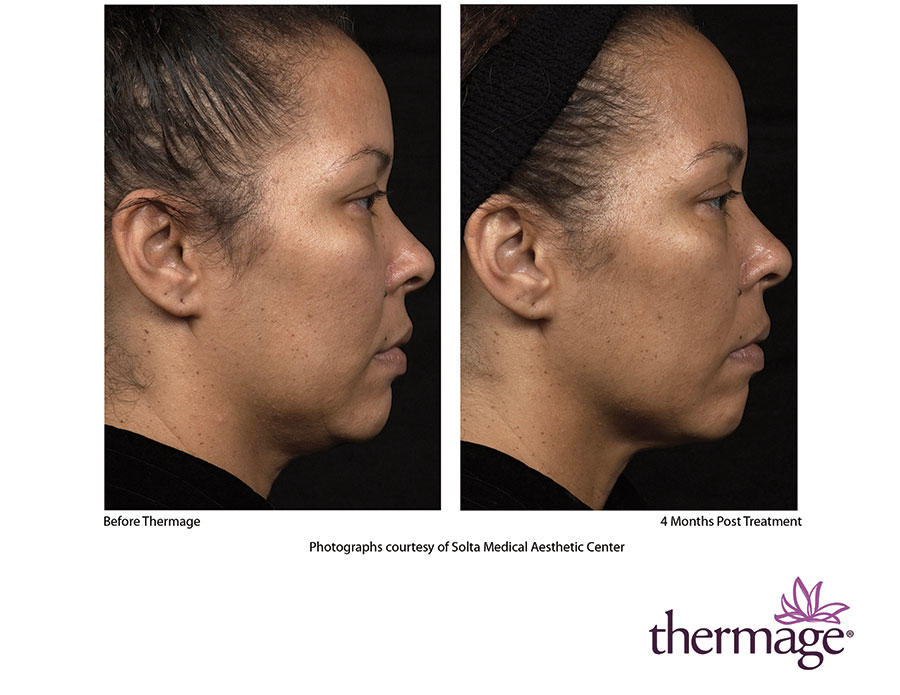 Thermage Skin Tightening Technology