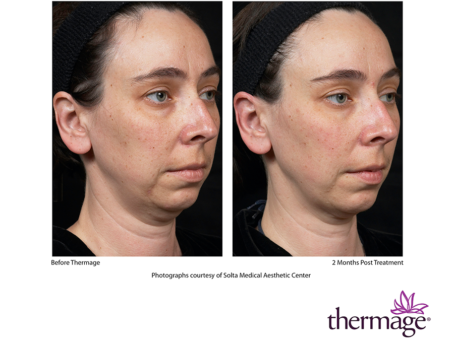 Thermage Skin Tightening Technology