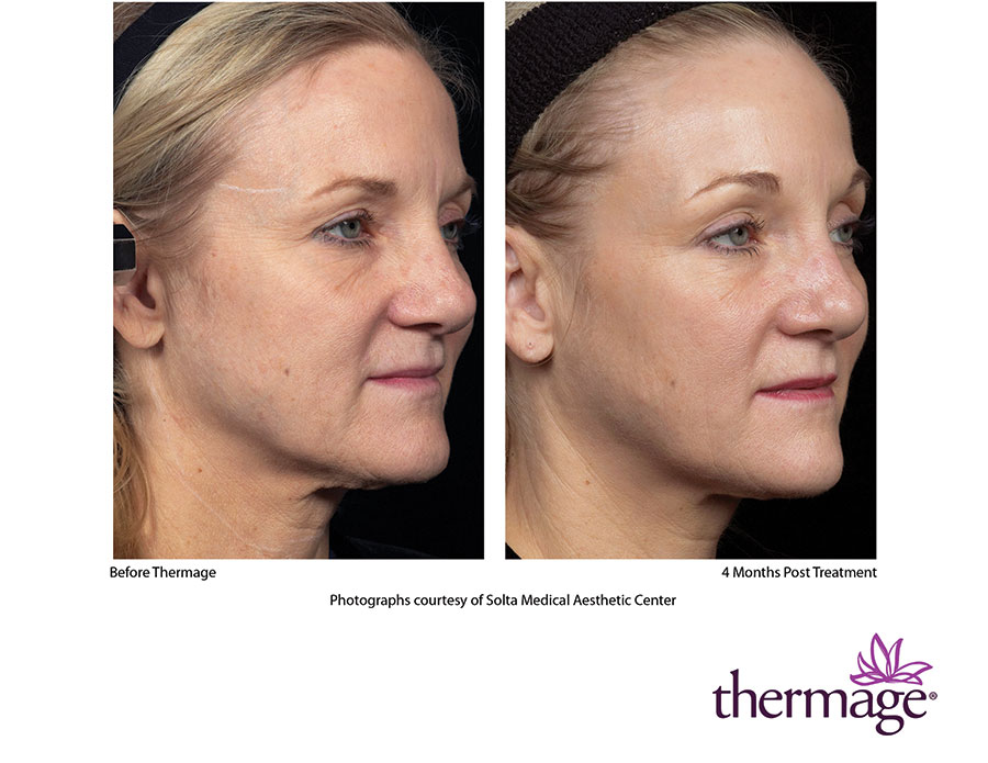 Thermage Skin Tightening Technology