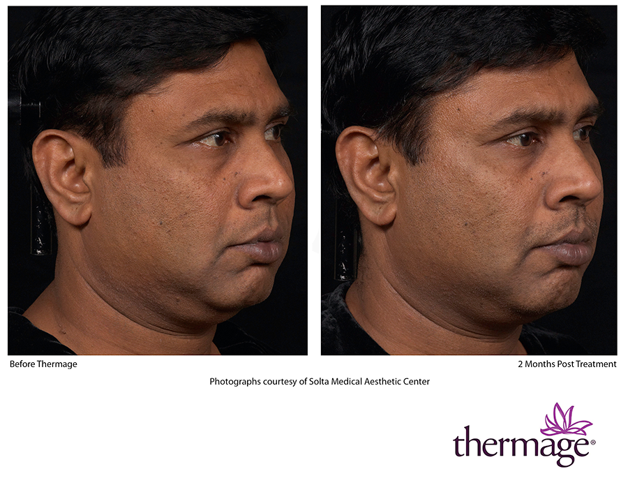 Thermage Skin Tightening Technology
