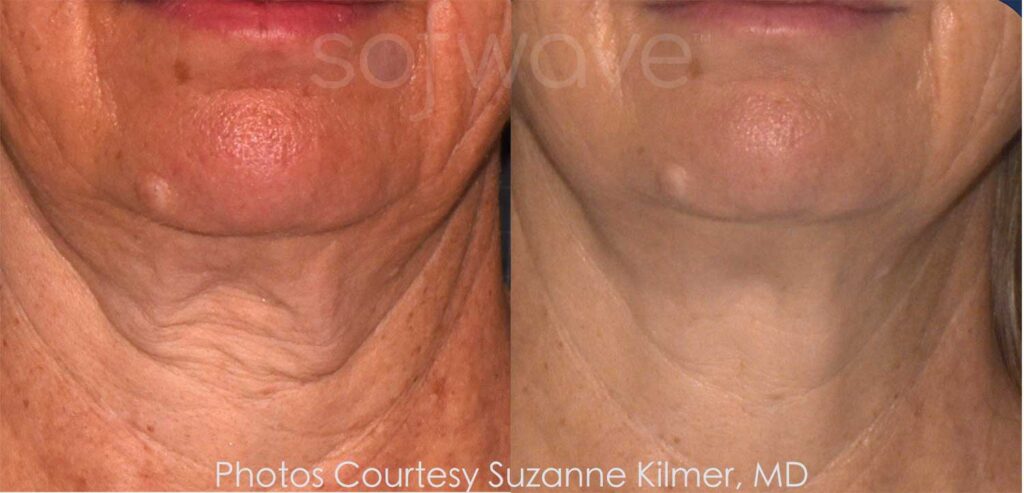 Sovwave before and after neck treatment