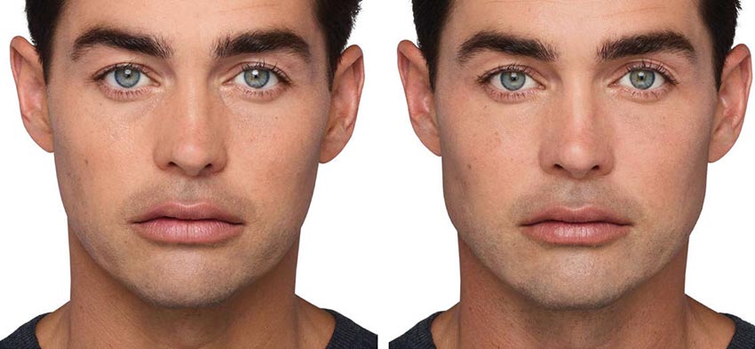 Volux filler used to define male jawline