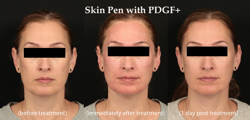 PDGF and SkinPen before and after