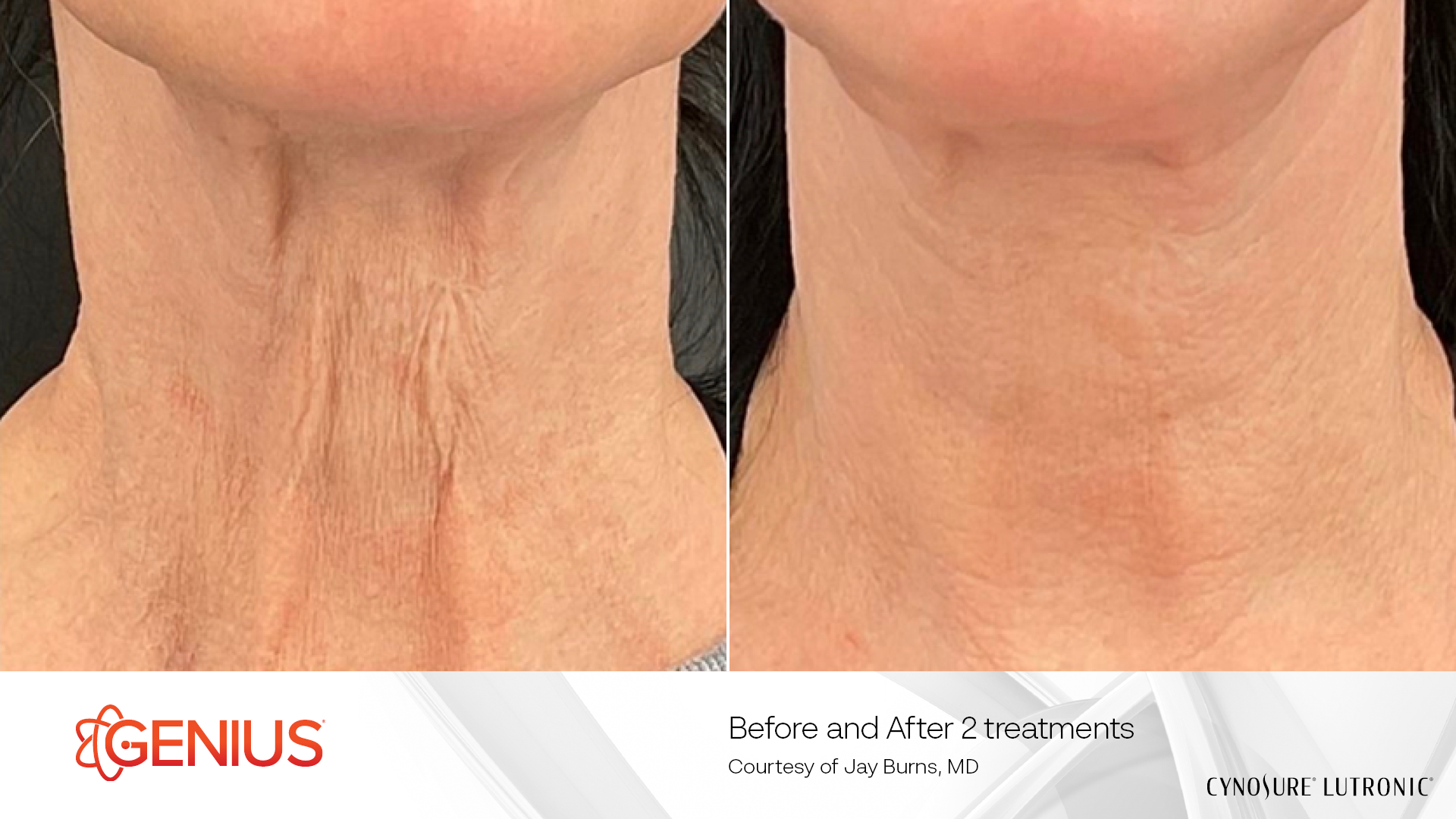 2 Treatments