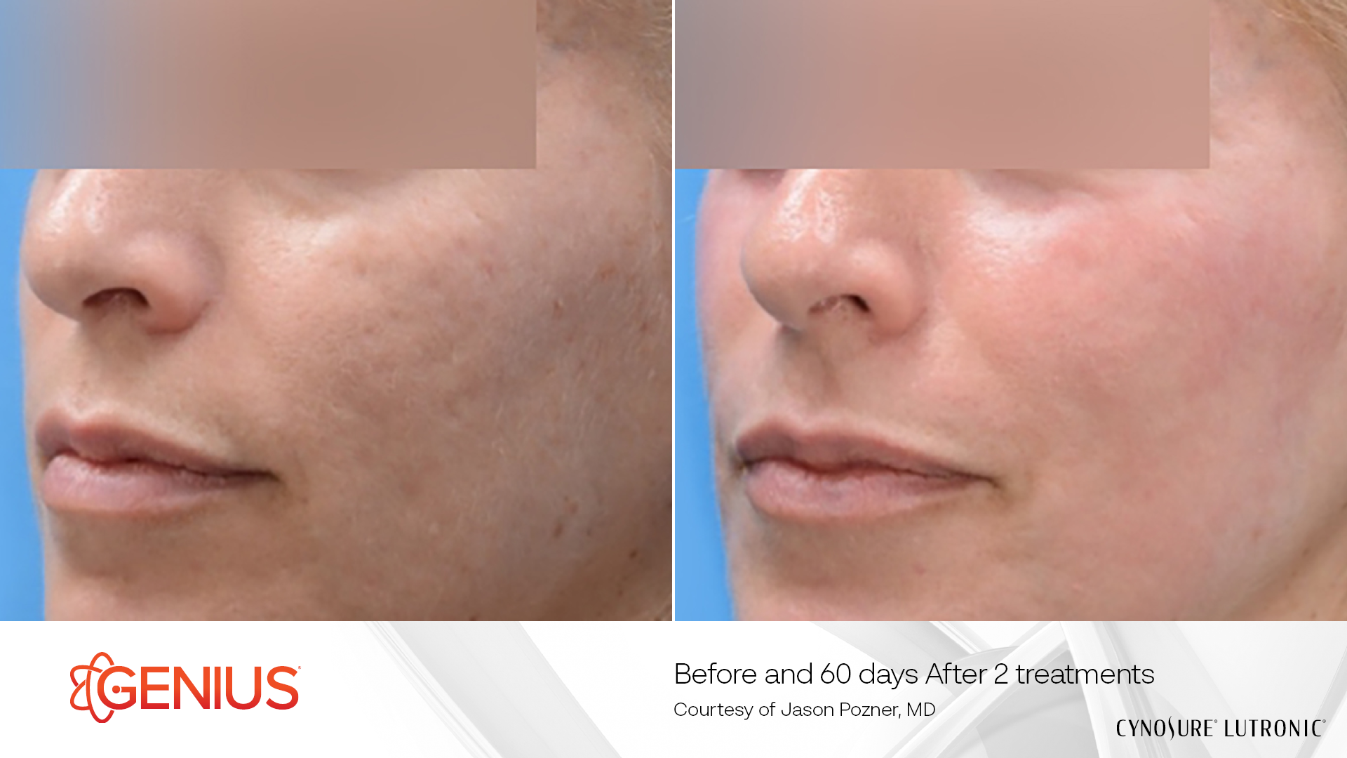 Two treatments Scarring
