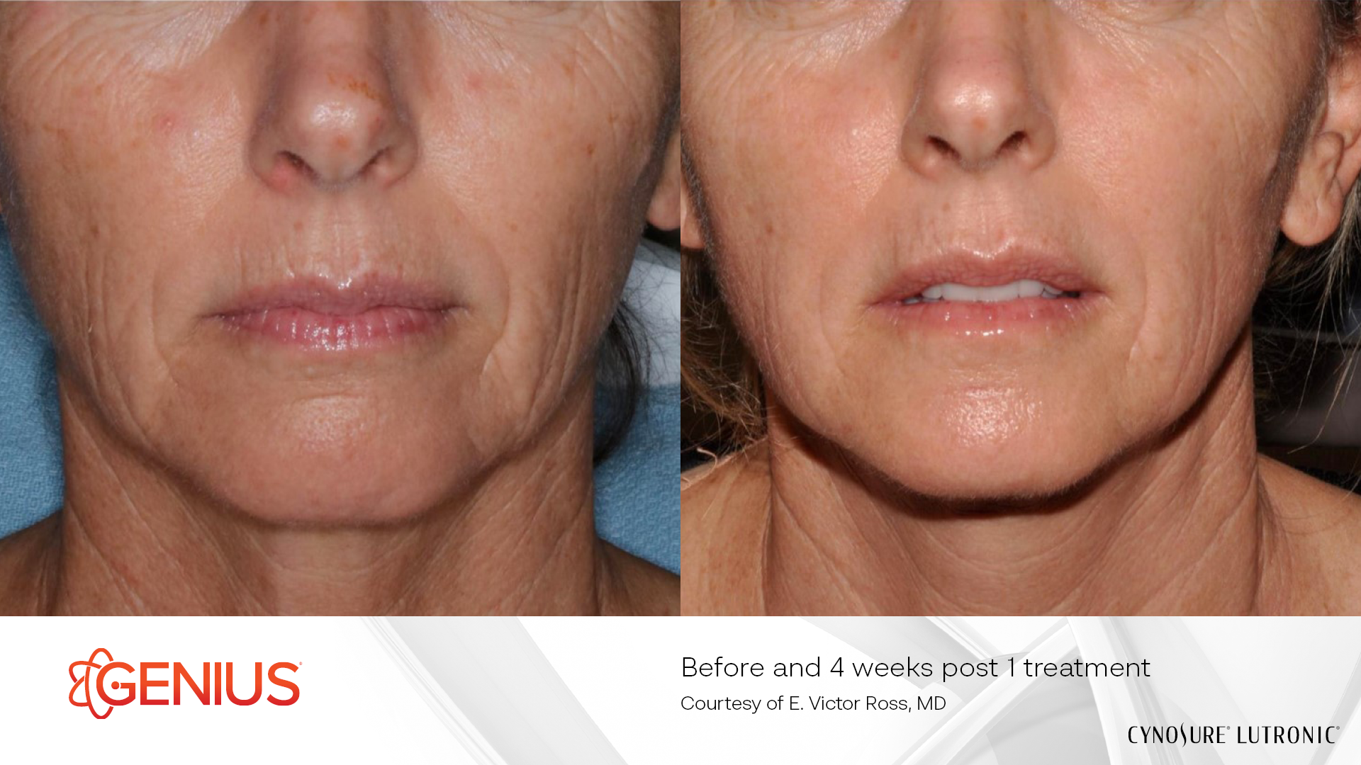 Single Treatment