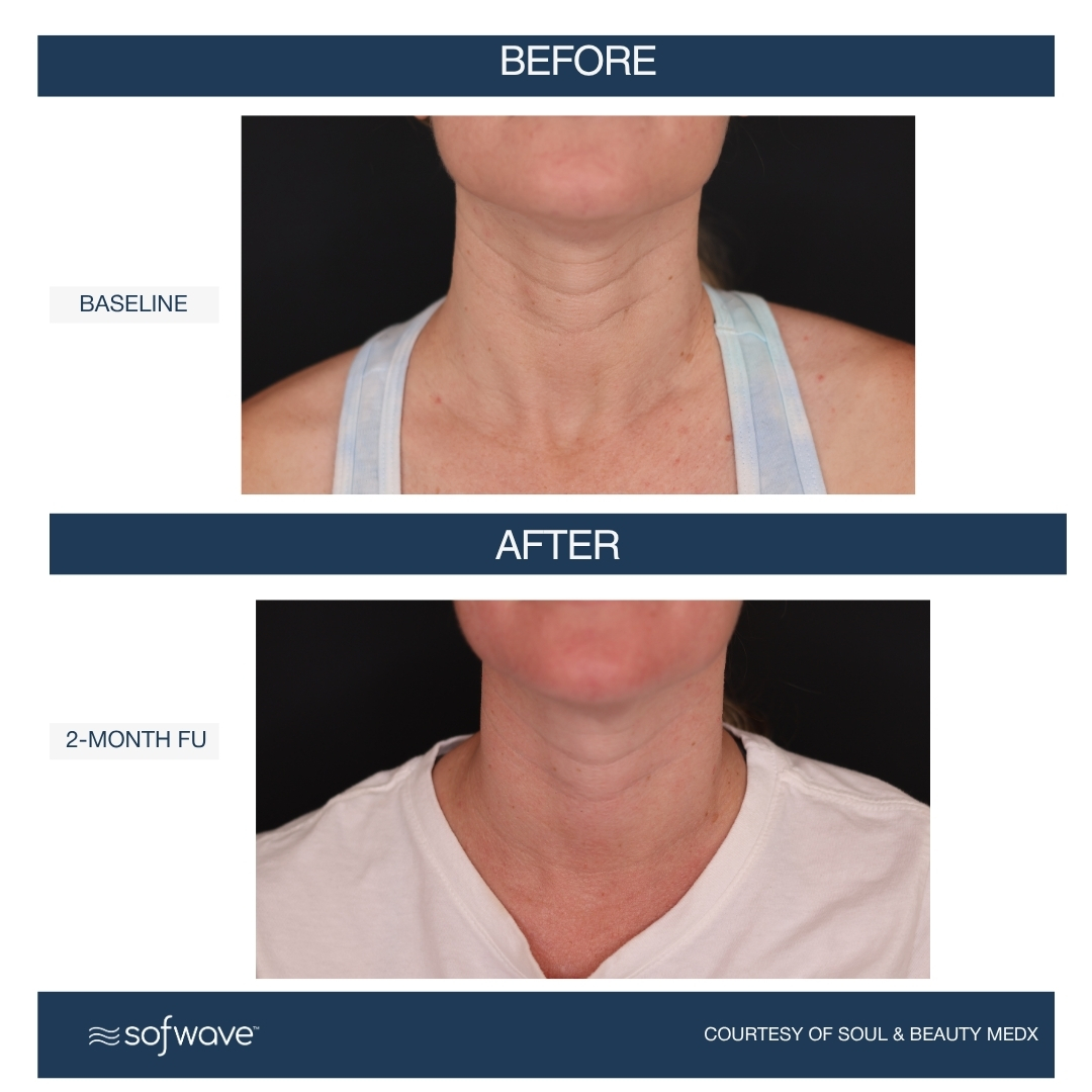Sofwave Neck