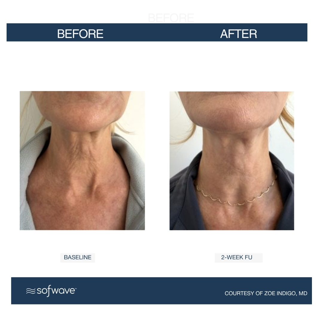 Sofwave Neck