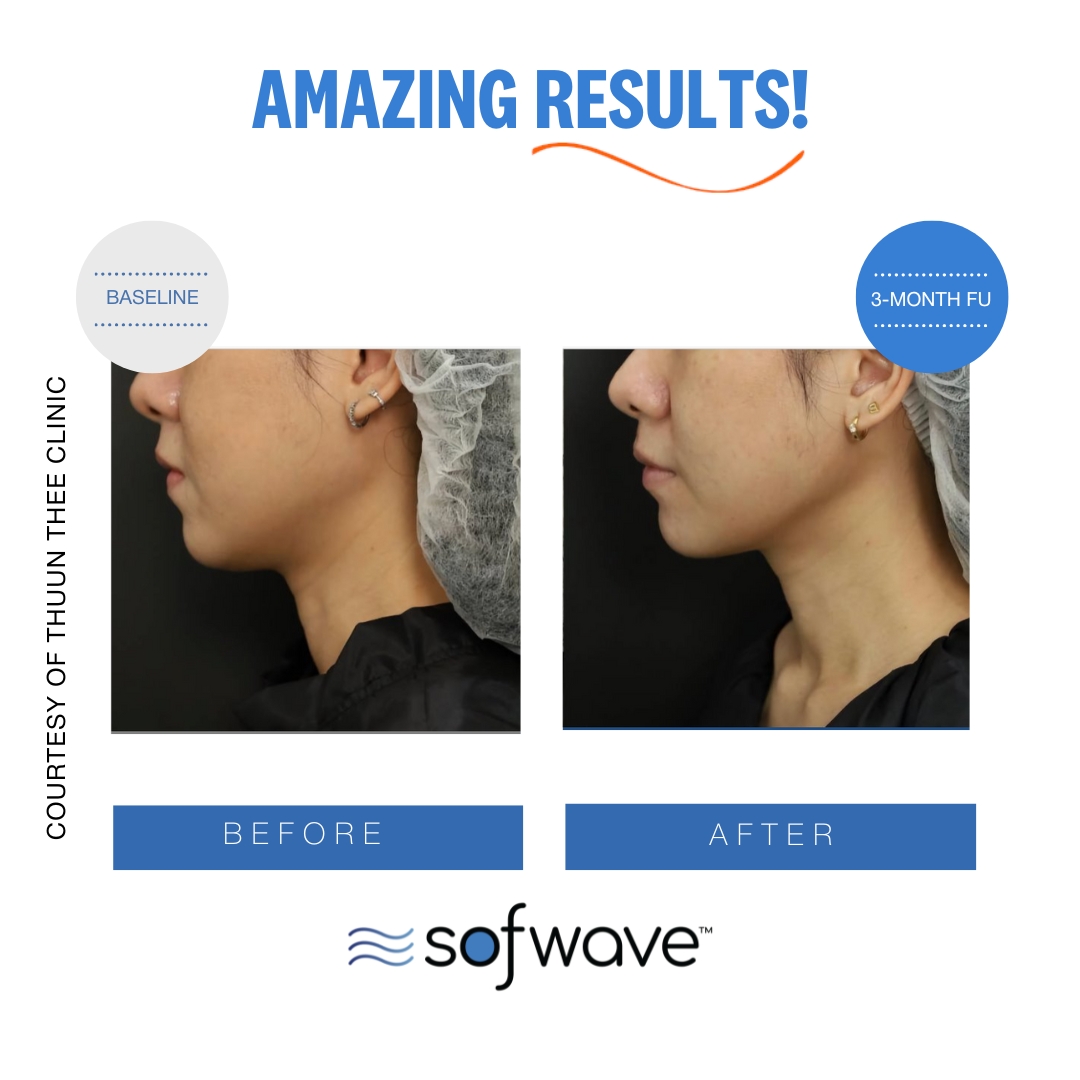 Sofwave-Set-55-Lower-Face-Skin-Type-4
