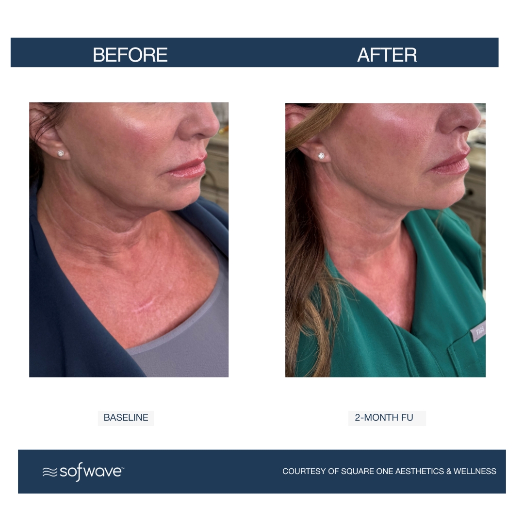 Sofwave Neck