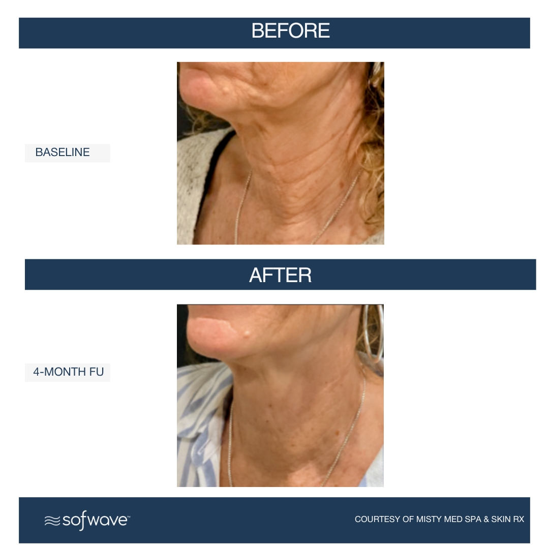 Sofwave Face & Neck