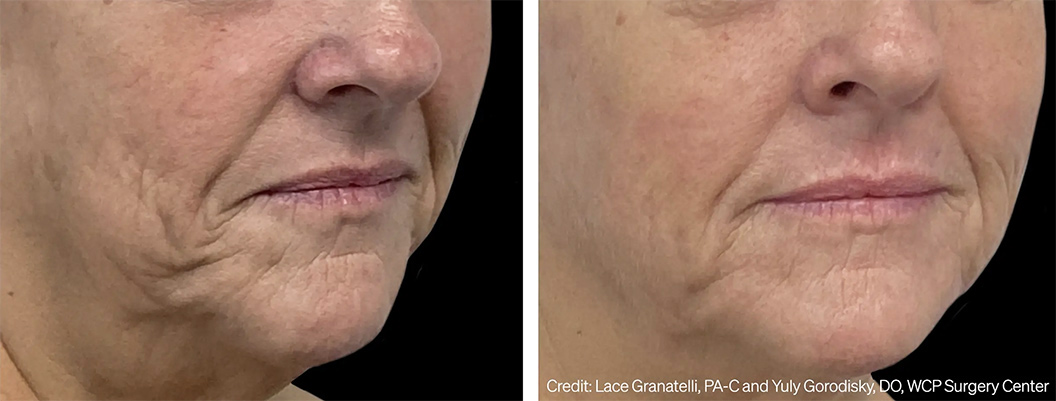 Ellacor 1 month post 2nd Treatment