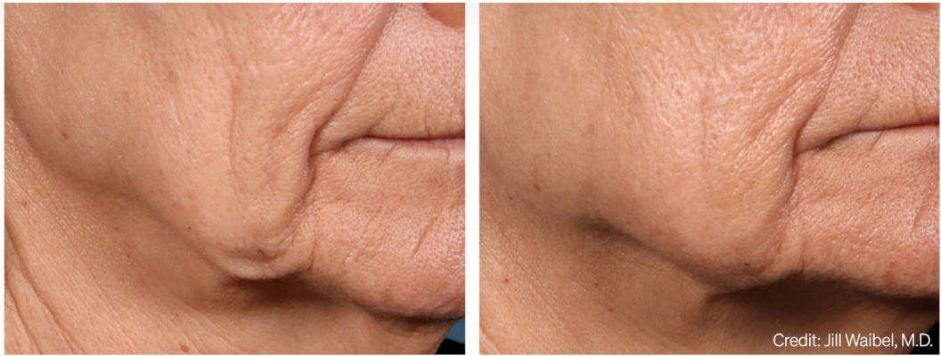 Ellacor Pre and Post 3 Months Single Treatment (Courtesy Jill Waibel, MD)