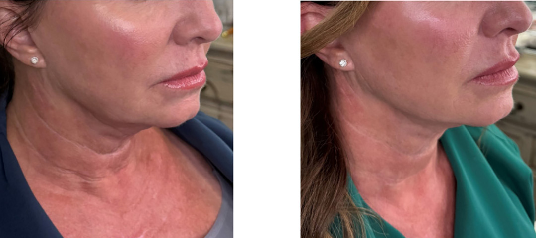 Sofwave Neck (Courtesy One Aesthetics & Wellness)