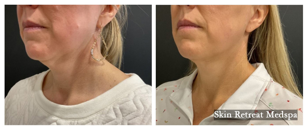 Sofwave Single Treatment Face & Neck