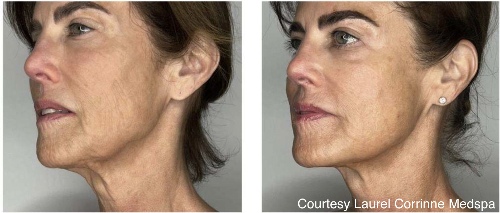 Sofwave Single Treatment
