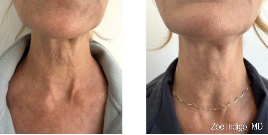 Sofwave Neck at 2 Weeks