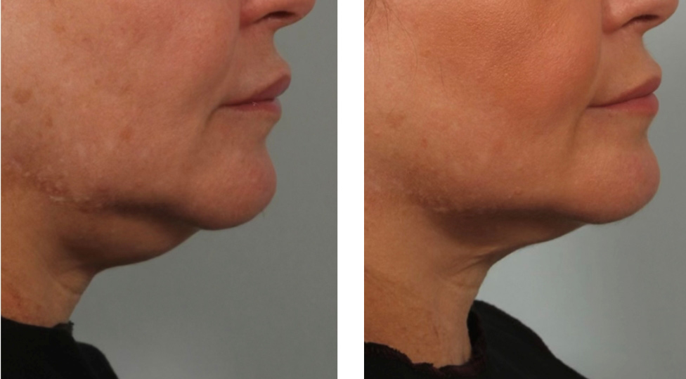 Sofwave Submental after 3 Months (Courtesy Skin I.D. Esthetics)