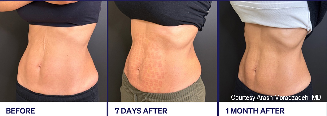 Ellacor Abdomen