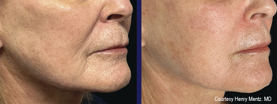 Ellacor 1 Treatment at 3 Months