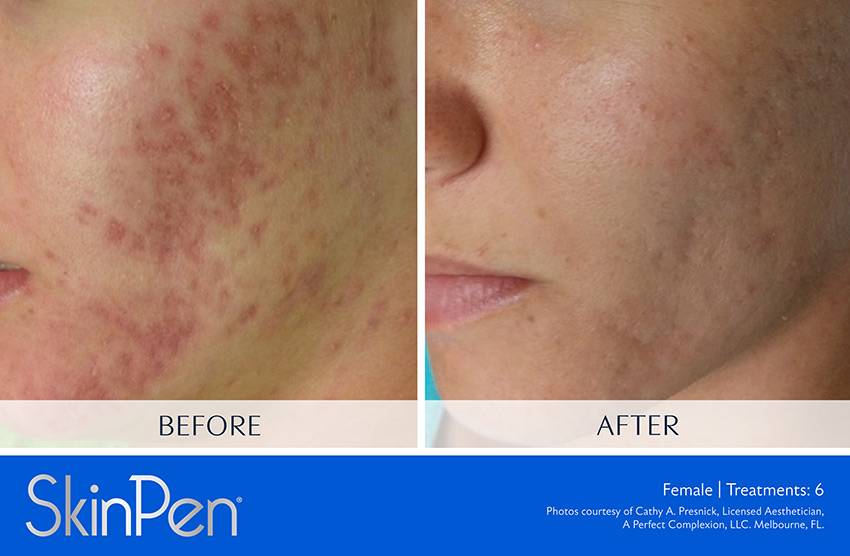 skinpen for acne scars before and after
