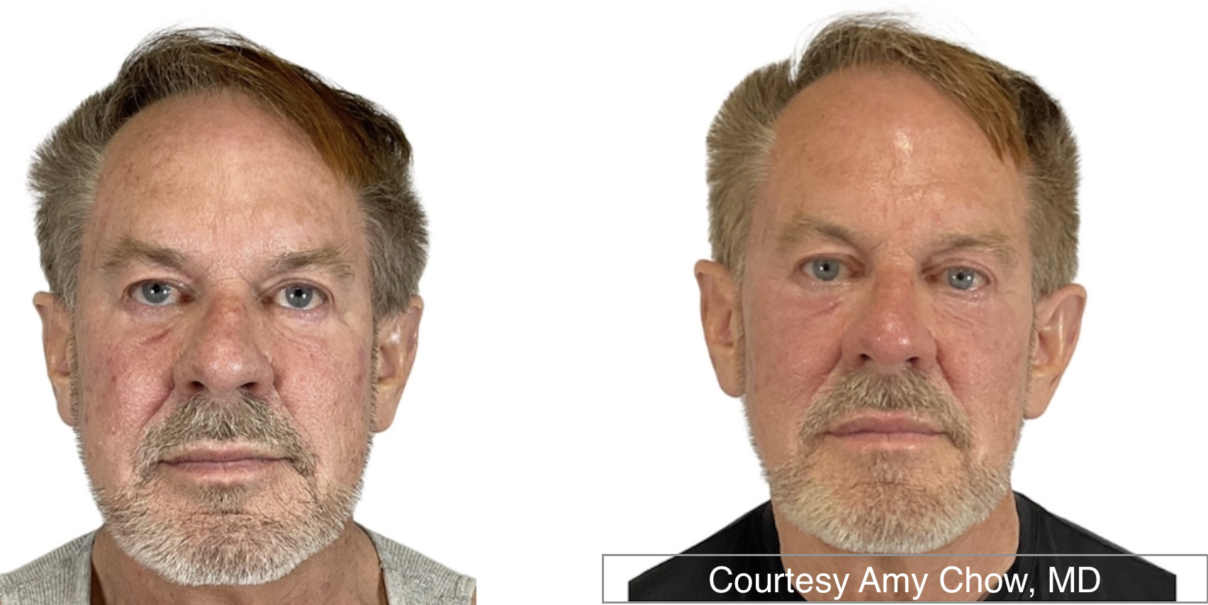 Sofwave Face Male